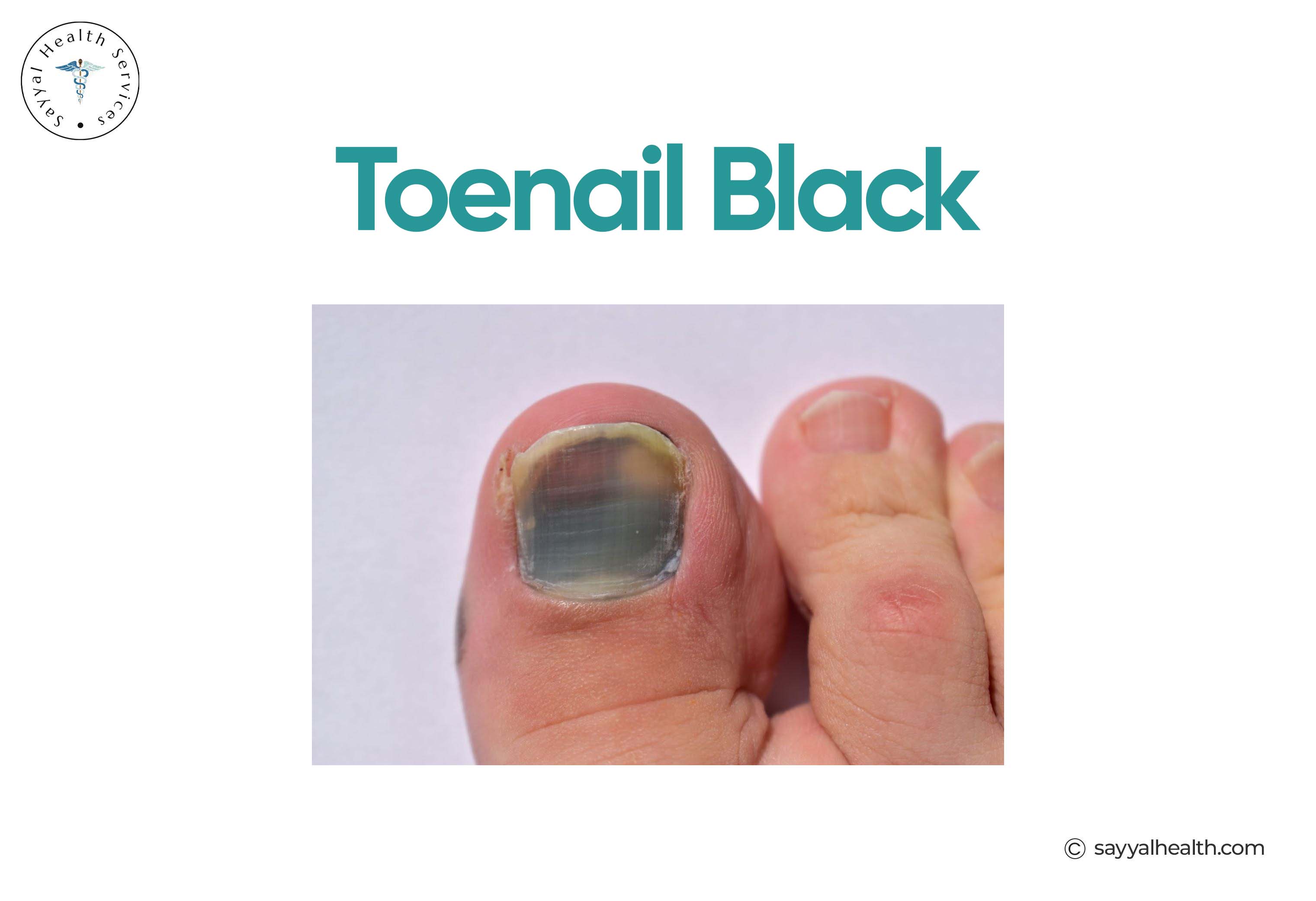 Toenail Black with Fungal Infection